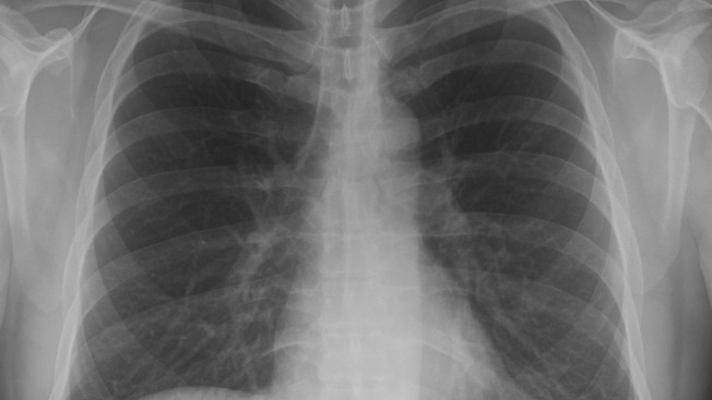 World Pneumonia Day on November 12: the leading infectious killer of young children